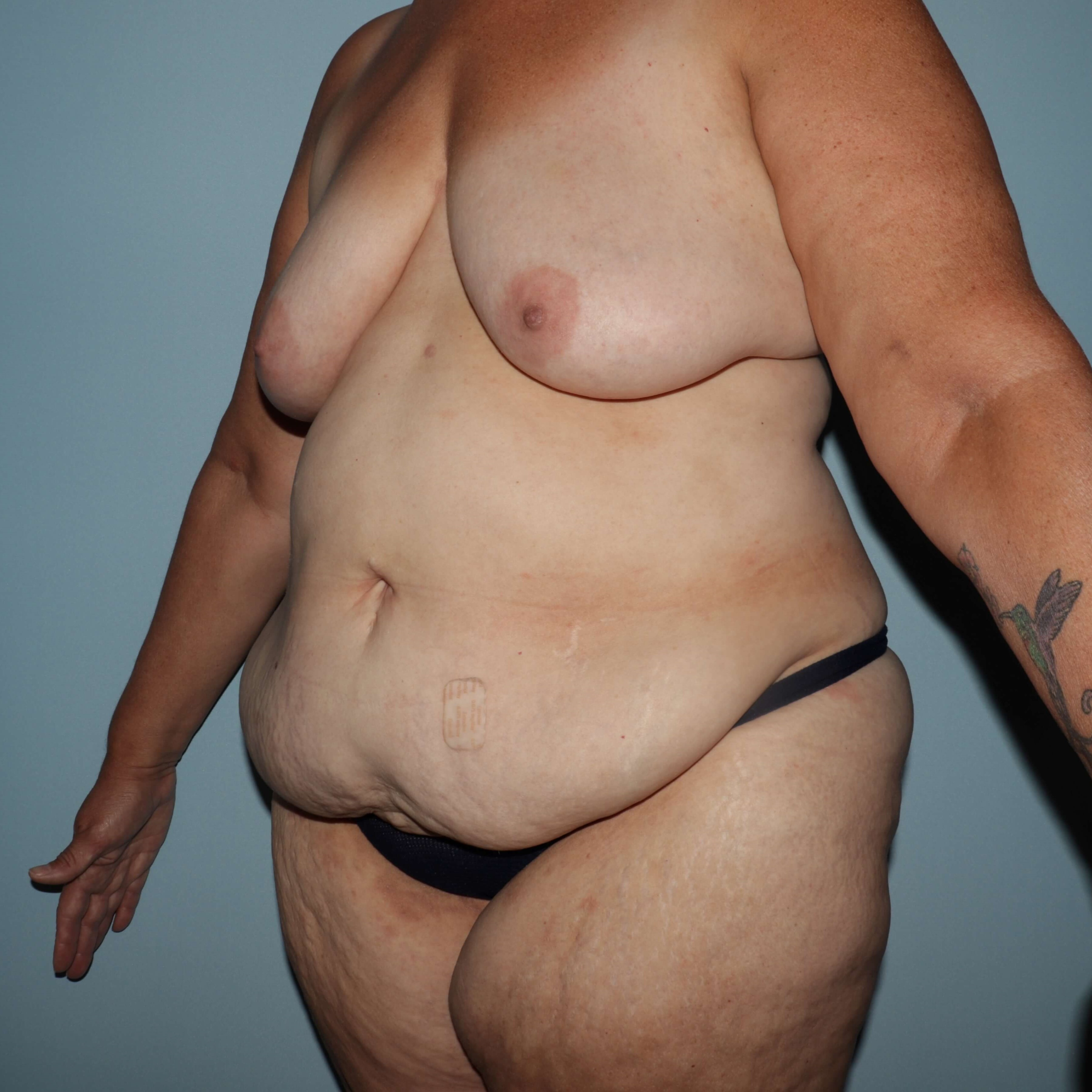 Preop